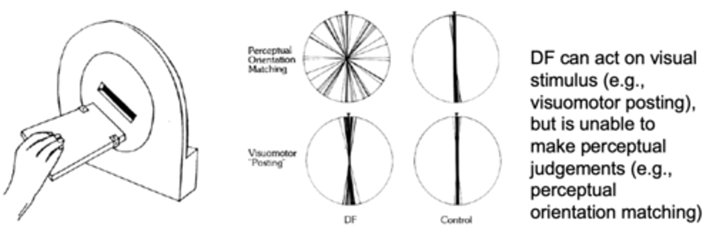 <p>- Extensive bilateral ventral-stream lesions has profound visual agnosia, but shows intact visually guided reaching.</p><p>- Temporal damage; had trouble matching orientation of card slot, but no trouble putting card through a slot ('what' pathway affected, 'how' pathway fine).</p>