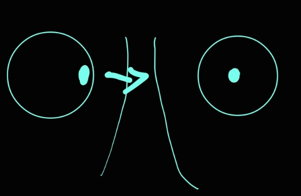 <p>medial rectus muscle</p>