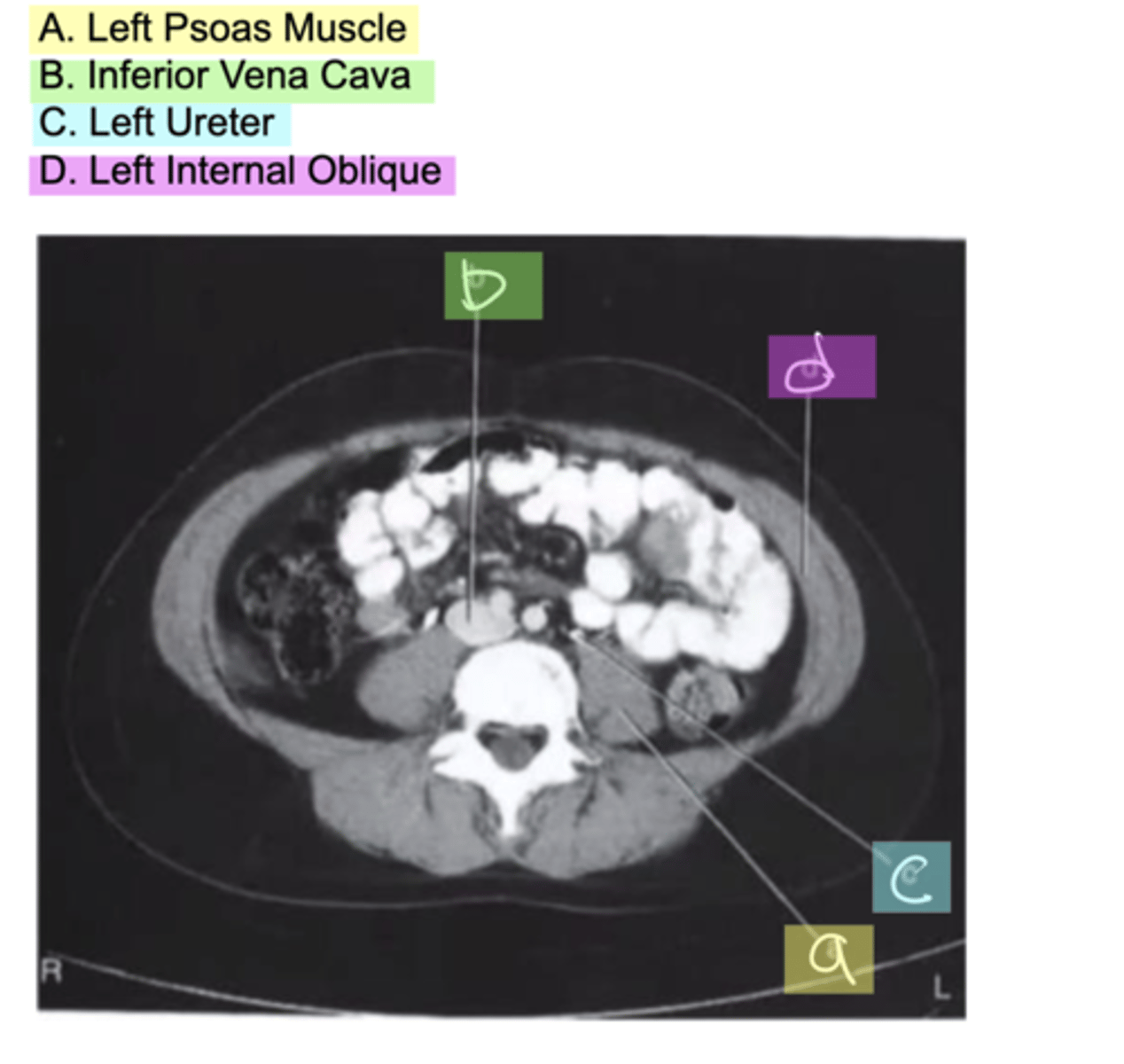 <p>A. Left Psoas Muscle</p><p>B. Inferior Vena Cava</p><p>C. Left Ureter</p><p>D. Left Internal Oblique</p>