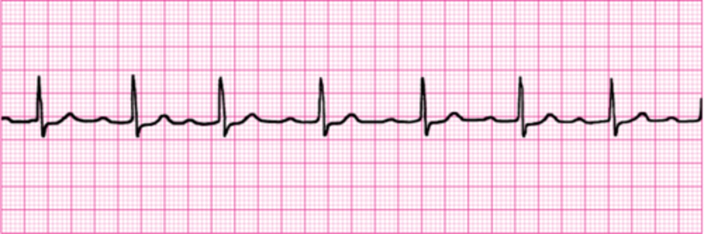 <p>Actually only a “delay” so all waves are present on the strip. With a 1st Degree AV Block, there is a P-wave for EVERY QRS-complex. Thus, nothing is “missing” and the PRI is consistently >0.20sec (5 small boxes) as measured on the ECG/EKG paper. Remember, the PRI WILL NOT CHANGE!</p>
