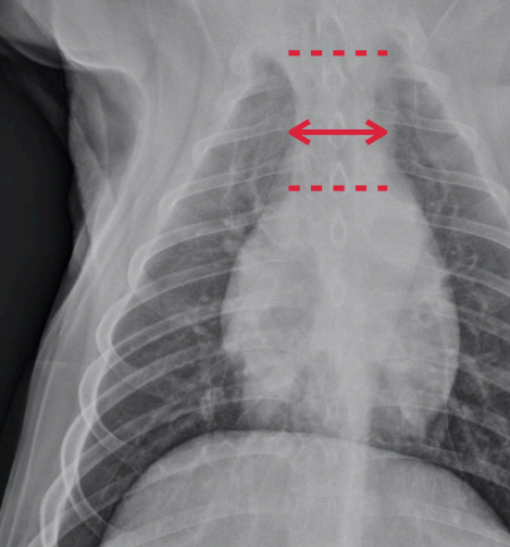 <p>• Measured on the VD view</p><p>• Locate the first ribs and the cranial border of the heart</p><p>• Measure the width half way between these structures</p>
