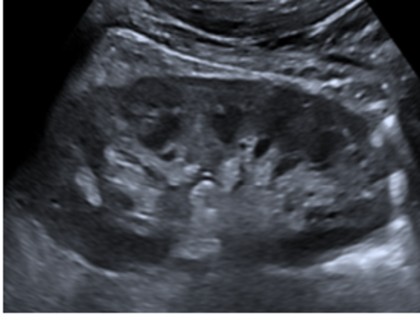 <p>El seno renal</p>