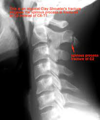 <p>An avulsion fracture of a spinous process in the lower C-spine or upper T-spine.</p>