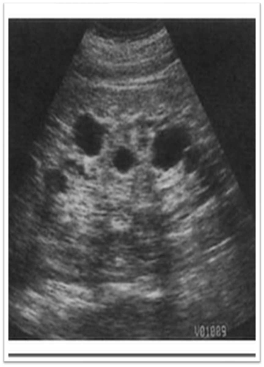 <p>acquired cystic kidney disease</p>