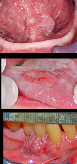 <p><span style="color: blue;"><strong><em><u>PRE-MALIGNANT NEOPLASMS</u></em></strong></span></p><p>Squamous Cell Carcinoma</p><ul><li><p>Clinical Signs</p></li><li><p>Location</p></li><li><p>Etiology</p></li><li><p>Treatment</p></li></ul><p></p>