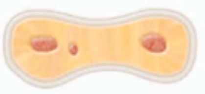 <p><span>marked by</span><span style="color: red;"><span> two or three canal</span></span><span> openings </span><span style="color: red;"><span>without</span></span><span> visible connections</span></p>