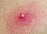 <p>Primary Skin Lesion</p><ul><li><p><strong>Pus</strong> filled lesion (yellow)</p></li><li><p>E.g., acne vulgaris</p></li><li><p>Presence means there is <strong>bacterial infection</strong></p></li></ul><p></p>