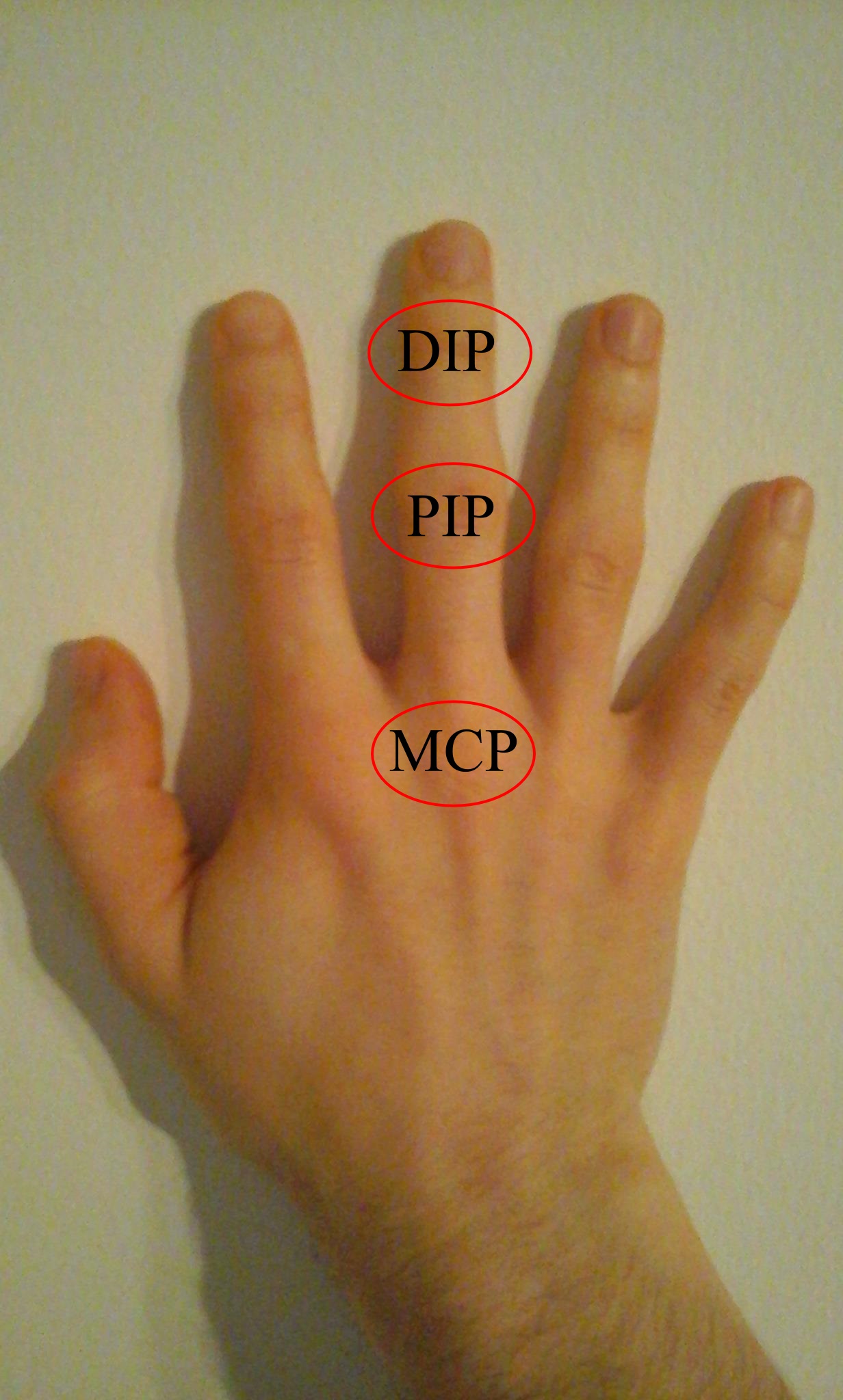 Middle-of-finger-joint repair (proximal-interphalangeal)