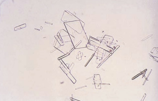 Cholesterol crystals