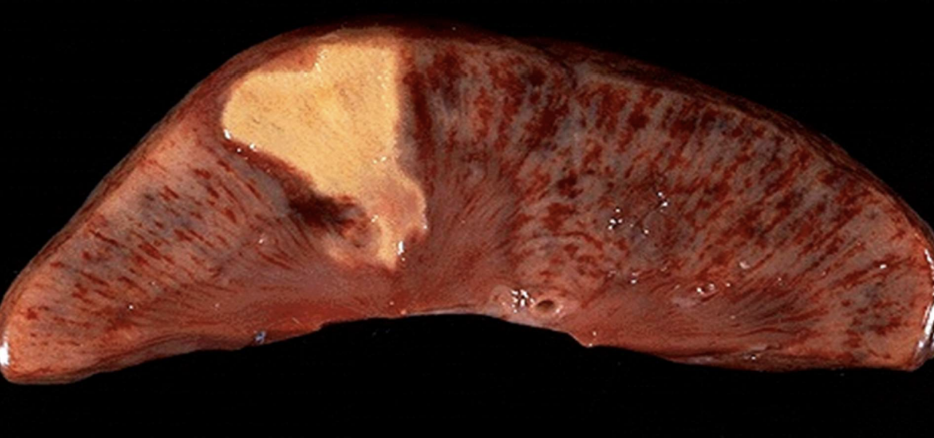 <p>Coagulative Necrosis</p>