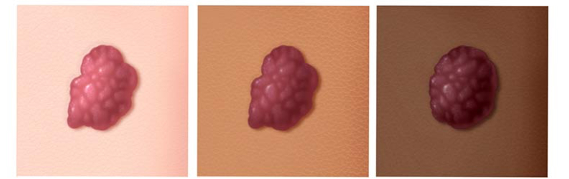 <p>Hemangioma</p>
