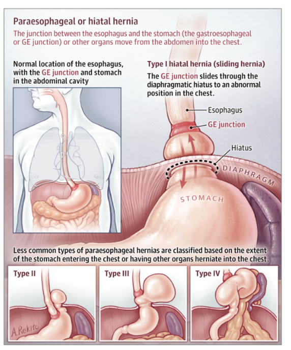 <p>Clinical drop — Hiatal hernia &amp; paraesophageal hernia</p>