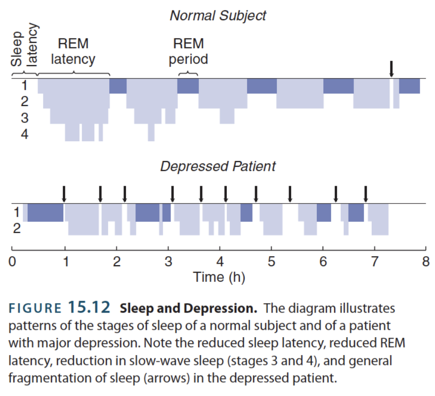<ul><li><p>Disordered sleep is a prominent symptom of depression </p></li></ul><p></p><p>Depressed people’s sleep …</p><ul><li><p>Spends more time in shallow, rapid-wave stages (1 &amp; 2)</p><ul><li><p>Enters REM sooner (earlier in a cycle) after falling asleep</p></li><li><p>Becomes more fragmented, with insomniac symptoms also occuring</p></li></ul></li><li><p>Spends little time in deeper, slow-wave stages (3 &amp; 4)</p><ul><li><p>Brain is supposed to rest this way!!!</p></li></ul></li></ul><p></p>