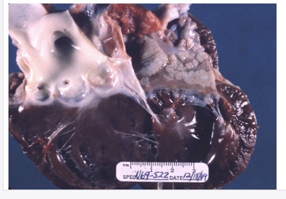 <p>multiple large white rough firm gritty plaques of mineralised fibroelastic tissue in endocardium + elastic arteries intima</p>