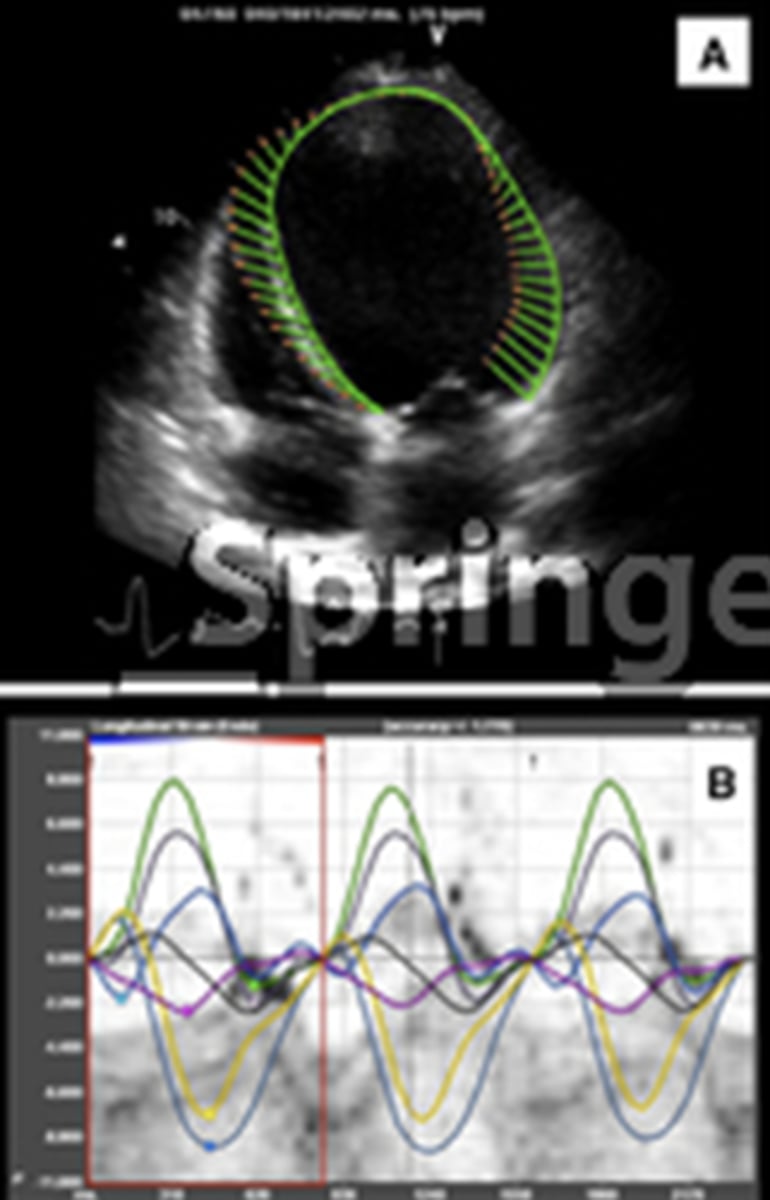<p>Uses strain rate to detect LV wall motion and myocardial thickening</p>