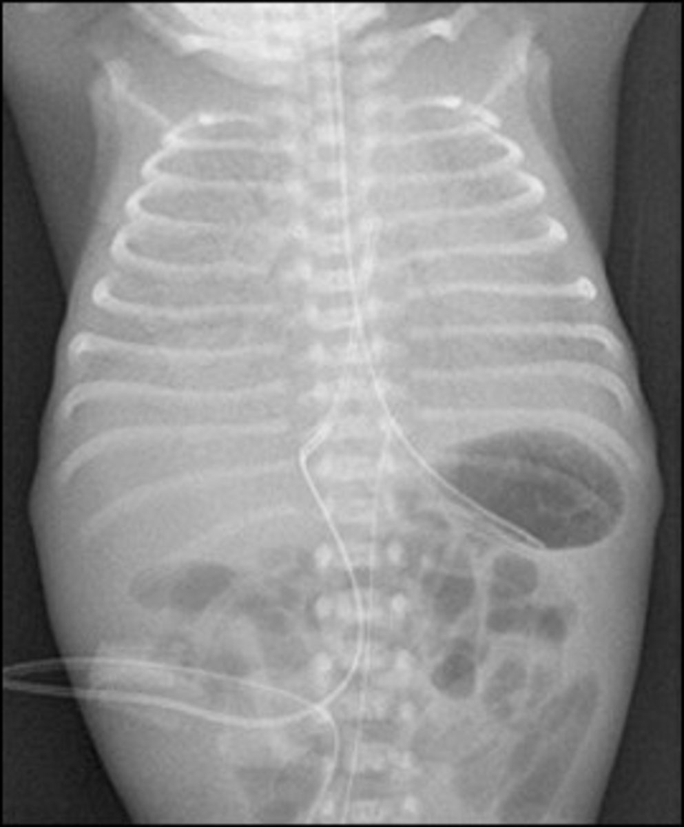 <p>32 wk premie has dyspnea, RR of 80 w/ nasal flaring.</p><p>- Prenatal Dx?</p><p>- Pathophys?</p><p>- Txt?</p>