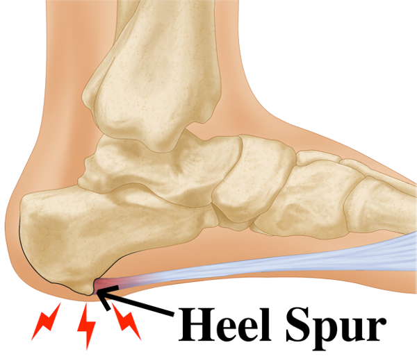 Calcification of the plantar fascia, hardened nodule, projection of bone