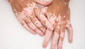 <p>skin condition in which melanocytes in certain areas lose the ability to produce melanin, possibly due to an autoimmune reaction that leads to loss of color in patches</p>