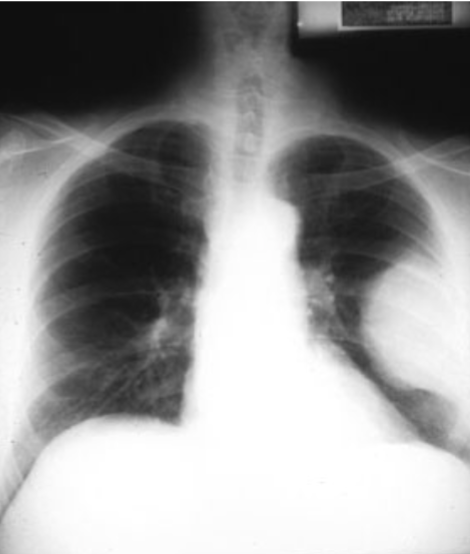 <p>result from old calcified empyema or asbestosis. Mesothelioma may appear as a focal pleural mass</p>