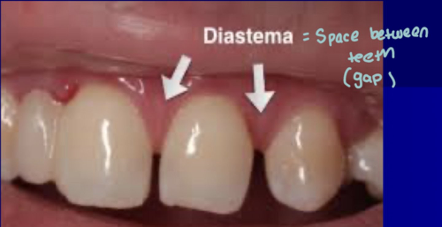 <p>Space between teeth</p>