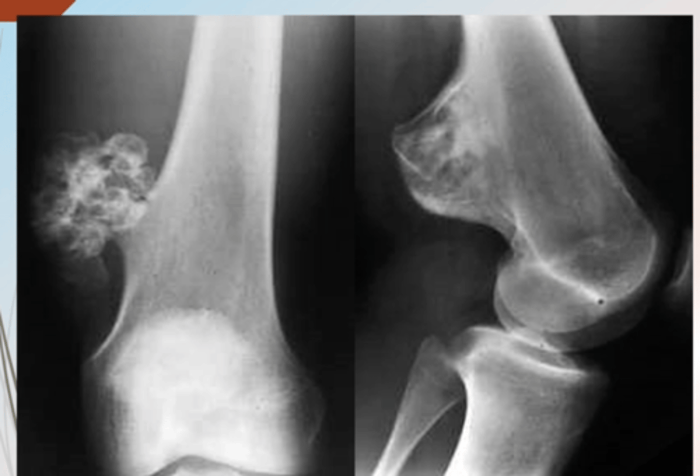 <p>benign bone tumor with a cartilage cap</p>
