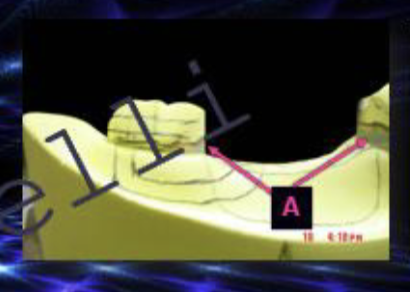 <p>what type of blackout is A</p>