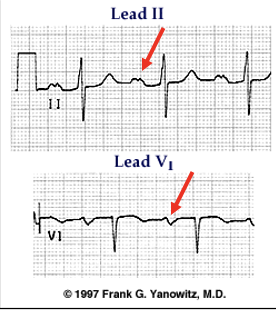 <p>Leads I, II, II: upright humped P wave</p><p>Lead V1: biphasic P wave w/ small + initial deflection and larger - terminal deflection</p>