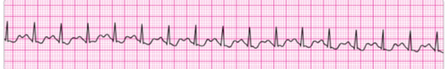 <p>Identify the rhythm.</p>