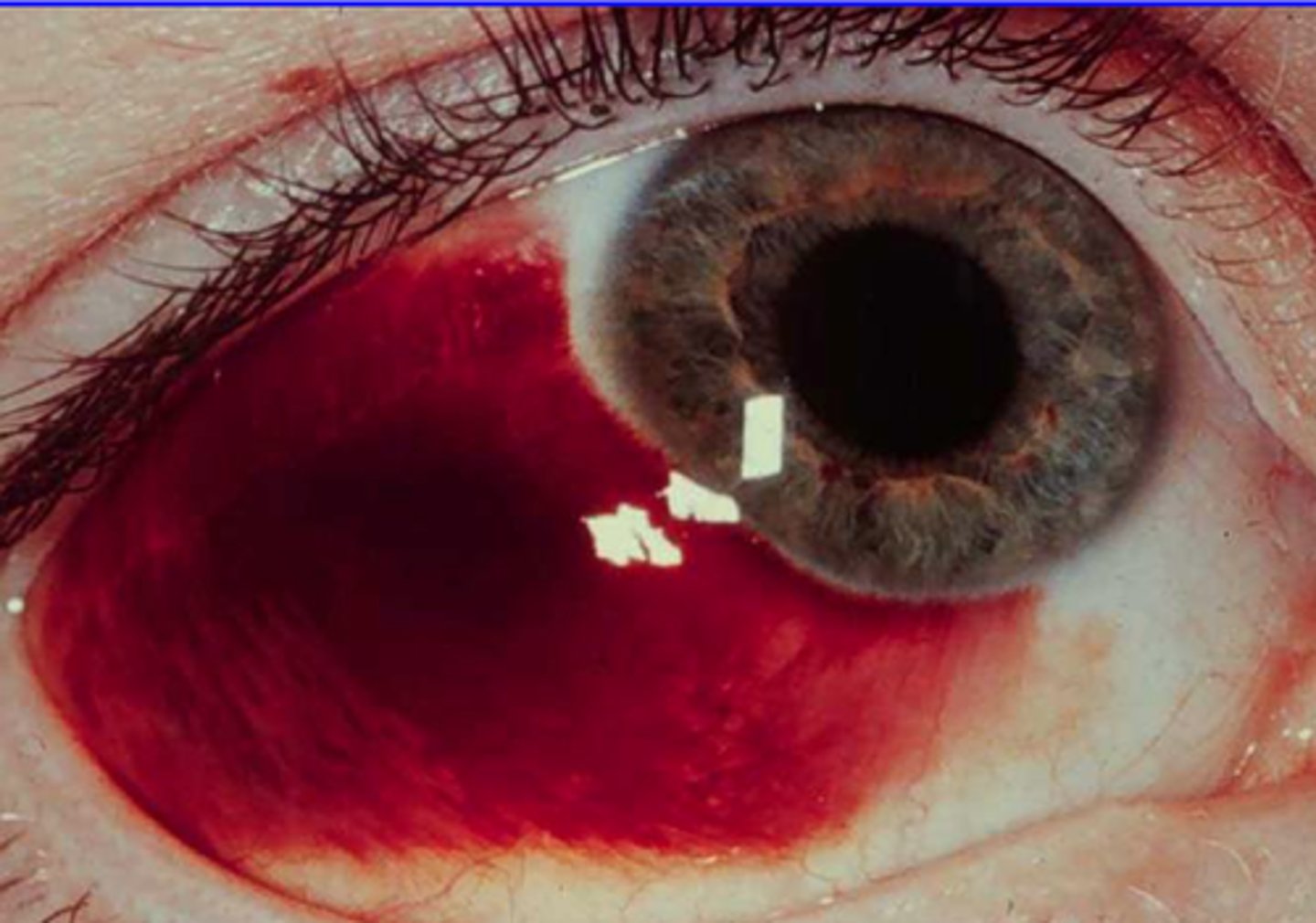 <p><span><u>Etio</u></span>: blood between the sclera and conjunctiva</p><p><span><u>Risk Factors</u></span>: childbirth, coughing, vomiting, uncontrolled HTN &amp; DM, blunt trauma, anticoagulation therapy</p><p><span><u>Tx</u></span>: resolves by itself in 2-4 weeks</p>