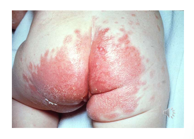 <ul><li><p>Buttocks, perianal, groin.</p></li><li><p>Erythema, scaling, satellite lesions</p></li><li><p><strong>1o or 2o invader?</strong></p></li><li><p>Association with<strong> faecal carriage of C. albicans - abrasion, urine and faeces → candida can get in </strong></p></li></ul><p></p>