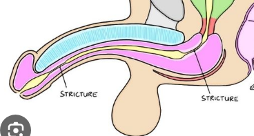 <p>Urethral stricture</p>