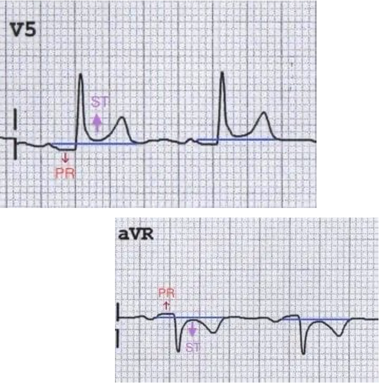 <p>PR seg depression</p><p>global concave ST seg elevation</p><p>w/ no reciprocal ST depression anywhere (except aVR and V1)</p><p>PR seg elevation in aVR</p>