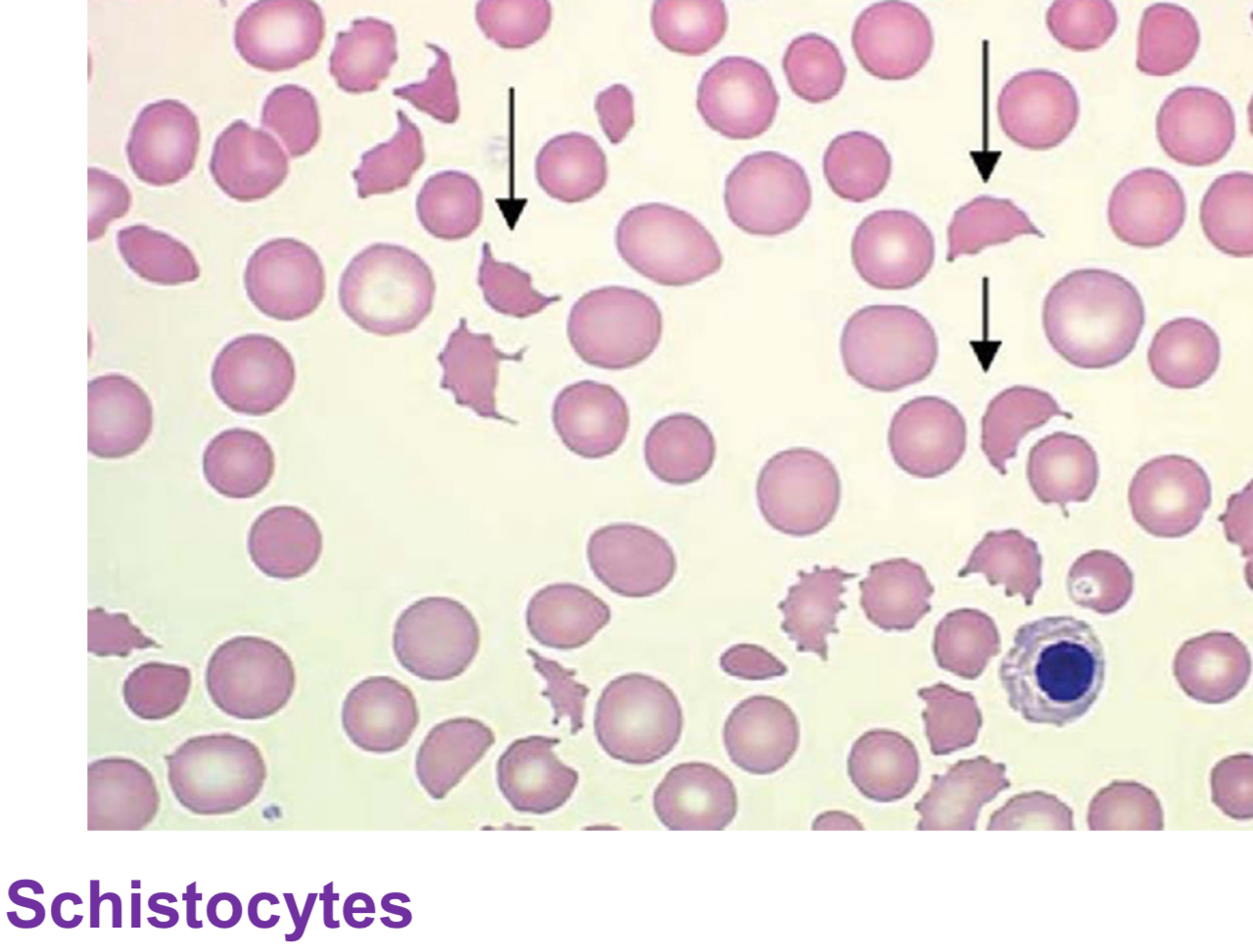 <p>schistocytes (small, bizarre shaped cell fragments)</p>