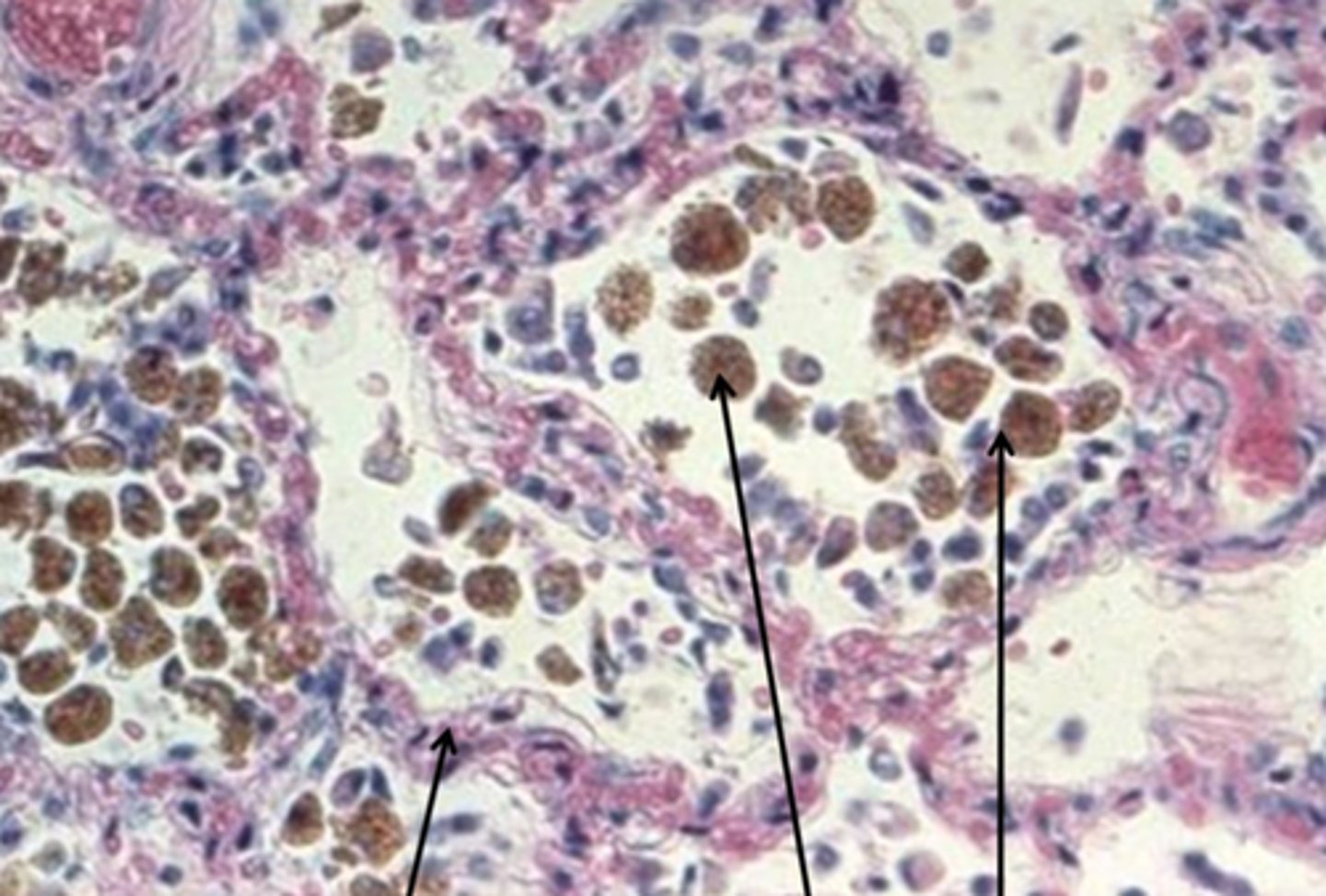 <p>presence of iron-containing pigment (hemosiderin) in urine (chronic hemolysis)</p>