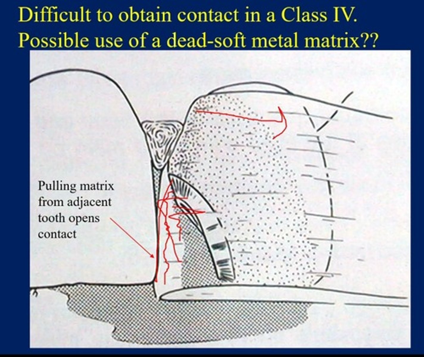 <p>We can lose proximal contact.</p><p>first build up proximal wall, cure, then add rest of composite and then pull matrix across.</p>
