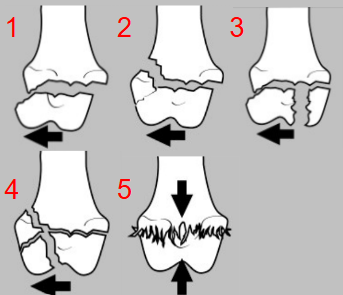 <ul><li><p><strong>Cause</strong></p><ul><li><p>skeletally <strong>immature</strong> &lt; 10 months</p></li></ul></li><li><p><strong>Salter Type I</strong></p><ul><li><p>Separation entire<strong> physis</strong></p></li><li><p>shearing forces</p></li><li><p>good prognosis </p></li></ul></li><li><p><strong>Salter Type II</strong></p><ul><li><p>most common </p></li><li><p>through <strong>physis</strong> and <strong>metaphyseal</strong> </p></li><li><p>triangular shaped bone frag</p></li><li><p>good prognosis </p></li></ul></li><li><p><strong>Salter Type III</strong></p><ul><li><p>through <strong>articular</strong> surface, <strong>epiphysis </strong>and <strong>physis</strong></p></li><li><p>intra-articular shearing force or a torsional force</p></li><li><p>Fair prognosis </p></li></ul></li><li><p><strong>Salter Type IV</strong></p><ul><li><p>through<strong> epiphysis, physis</strong>, and <strong>metaphysis</strong></p></li><li><p>often <strong>older </strong>animals</p></li><li><p>poor prognosis </p></li></ul></li><li><p><strong>Salter Type V</strong></p><ul><li><p>through<strong> physis</strong></p></li><li><p><strong>severe</strong> crushing forces</p></li><li><p>poor prognosis </p></li></ul></li></ul><p></p>