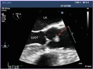 <p>Second most common primary benign tumor of the heart.</p><p>Arises on valvular tissue.</p><p>Found on the downstream side of the valve - LV side of the MV or aorta side of the AV.</p><p>Usually no clinical significance other than possibility of thrombus and emboli.</p>