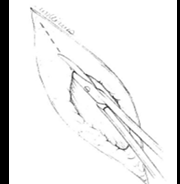 <p>Which type of dissection technique?</p>