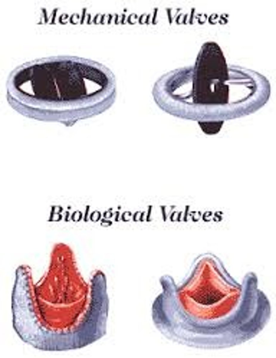 <p>mechanical valves</p><p>1) increase durability</p><p>2) need anticoag therapy forever </p><p>3) used in clients &lt;65 y.o.</p><p>Tissue valves</p><p>1) from porcine or bovine</p><p>2) NO anticoag therapy</p><p>3) don't last as long</p>