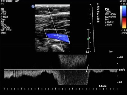 <p>Does this doppler waveform show a vessel that displays spontaneity or patency?</p>