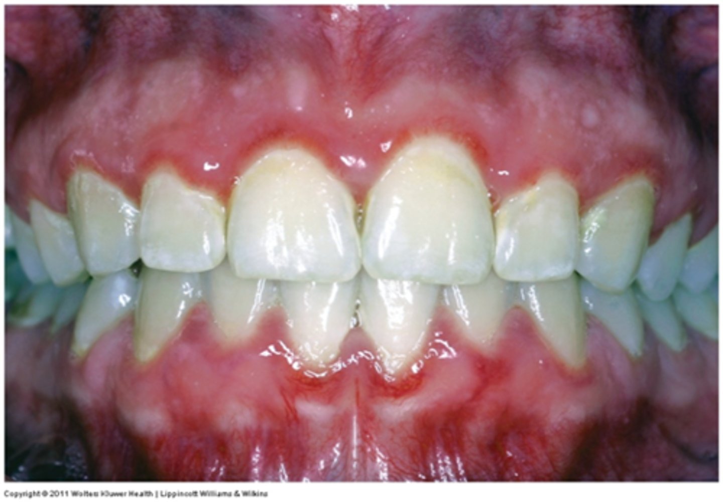 <p>hormonal gingival hyperplasia</p><p>• population: females</p>