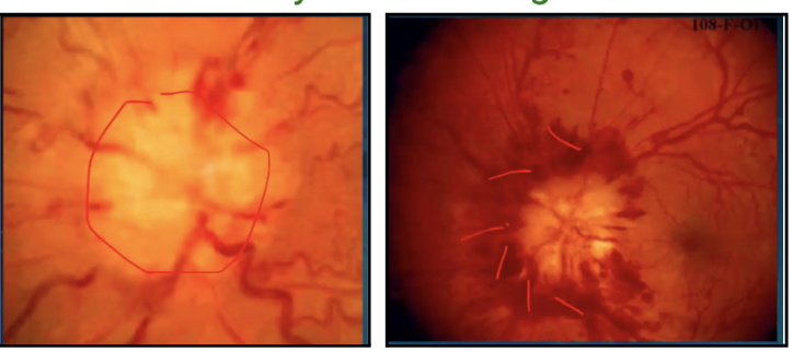 <p>Papilledema</p>