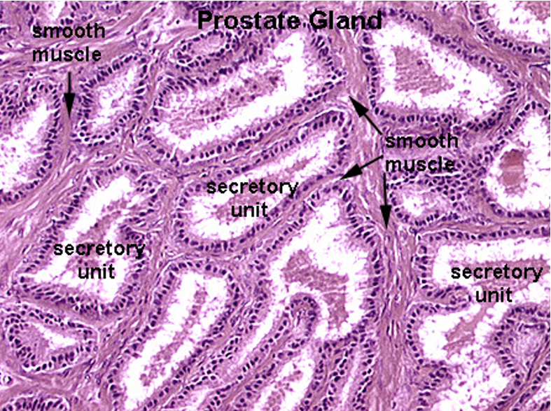 <p><strong>Prostate</strong></p><ul><li><p class=""><strong>Multiple secretory glands </strong></p></li><li><p class=""><strong>Corpora amylacea</strong> (round, eosinophilic concretions) often seen in gland lumens</p></li><li><p class="">Glands vary in size and shape</p></li></ul><p></p>