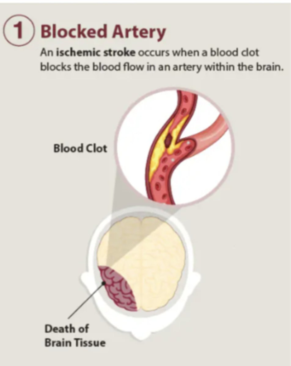 <p>stroke caused by a blocked artery, most common after thrombus or atherosclerosis</p><p>85% of strokes </p>