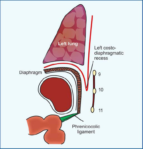 <p>(1) 9th, 10th and 11th ribs and the intercostal structures.</p><p>(2) Left pleura and the left lung</p>