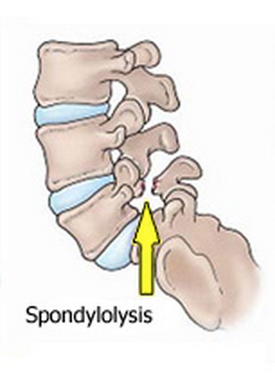 <p>the breaking down of the vertebral structure</p><p>- hereditary</p><p>- soft tissue damage</p>