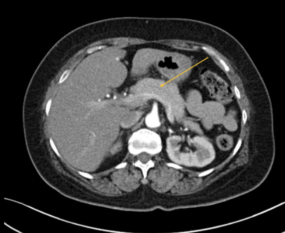 <p><span style="color: #00d8b8">CT Pancreas</span> additional oral contrast given to help differentiate</p>