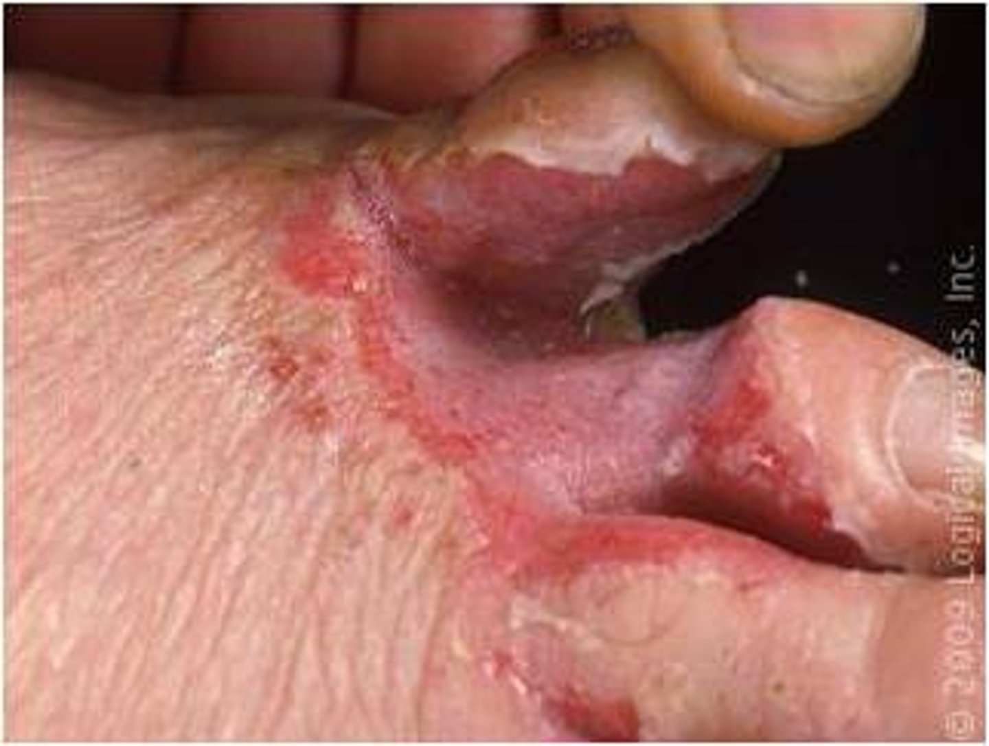 <p>Erosions (secondary lesion)</p>