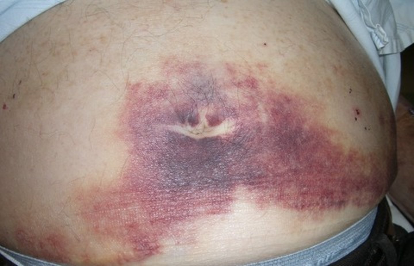 <p>hemorrhagic discoloration of the umbilical area</p><p>Hemorrhage</p>