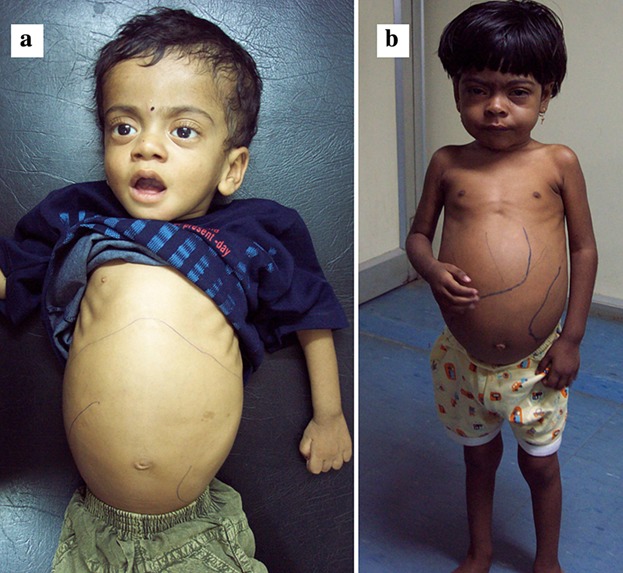 <p>Niemann-Pick disease</p>